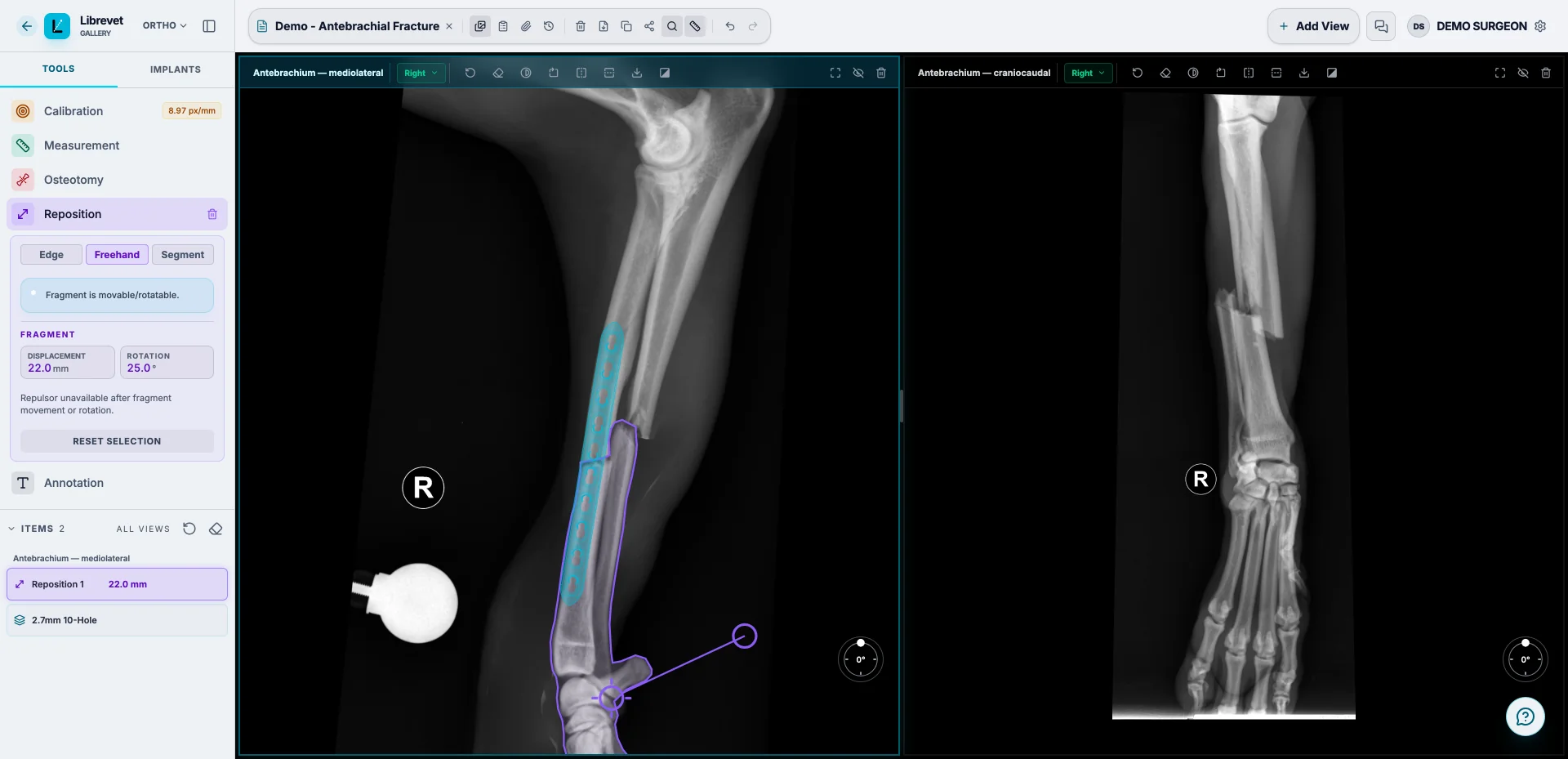 Librevet planning a right radius and ulna fracture: the distal segment traced, turned 25 degrees and moved 22 mm back into line, and a 2.7 mm ten-hole plate templated on the cranial radius at true scale, with the craniocaudal view alongside.
